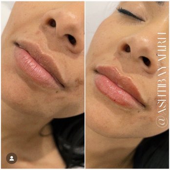Glow Up Med Spa - Lip filler - Medical Spas Near Me - Cypress, California Glow Up Med Spa - Lip filler - Medical Spas Near Me - Cypress, California