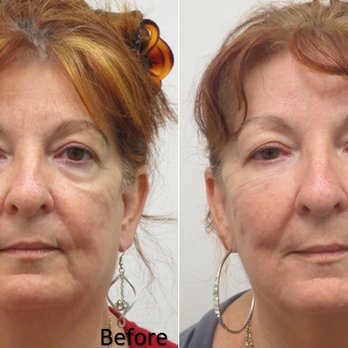 True Vision Center - Liquid Face Lift - Ophthalmologists Near Me - Honolulu, Hawaii True Vision Center - Liquid Face Lift - Ophthalmologists Near Me - Honolulu, Hawaii