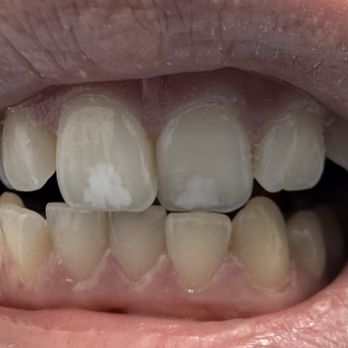 Norco Modern Dentistry - Before icon resin infiltration - General Dentistry Near Me - Norco, California Norco Modern Dentistry - Before icon resin infiltration - General Dentistry Near Me - Norco, California