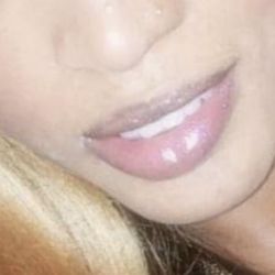 South Florida Center for Cosmetic Surgery - Before surgery. I just wanted the bridge of my nose to be narrowed and I told him prior to the surgery what I want the outcome to be.