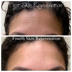 Sthree Skin Care - Reveal smoother, brighter, more youthful-looking skin with Laser Skin Rejuvenation!