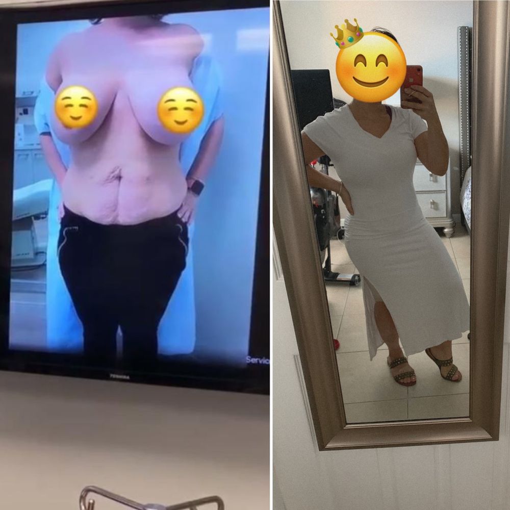 Just 10 days between both pics. STILL swollen, still healing, and already looking DRASTICALLY different! Thank you Dr. Earle! ♥ Just 10 days between both pics. STILL swollen, still healing, and already looking DRASTICALLY different! Thank you Dr. Earle! ♥