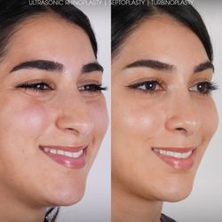 Kian Karimi, MD FACS - Ethnic NoseTune™ rhinoplasty enhancing facial harmony with refined bridge and tip while preserving natural features.