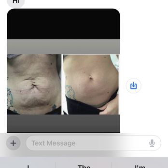 LaserAway - False advertised photos they sent me - Laser Hair Removal Near Me - Miami, Florida LaserAway - False advertised photos they sent me - Laser Hair Removal Near Me - Miami, Florida