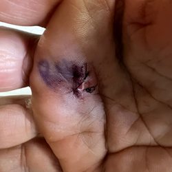 Brian T Hardy, MD - My surgery as it heals.