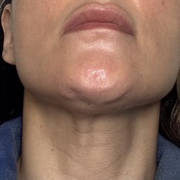 Bumpy jawline as a result of a poorly placed radiesse product in the jawline Bumpy jawline as a result of a poorly placed radiesse product in the jawline