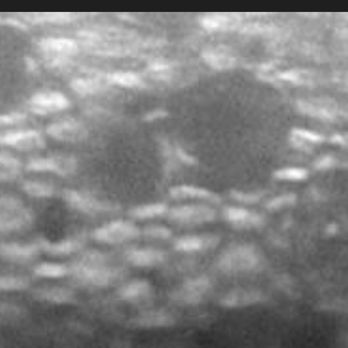 Sumit Garg, MD - Craters = back of the cornea lining dead cells. Lining works to draw away fluid to prevent swelling. TY UCI!!! - Ophthalmologists Near Me - Irvine, California Sumit Garg, MD - Craters = back of the cornea lining dead cells. Lining works to draw away fluid to prevent swelling. TY UCI!!! - Ophthalmologists Near Me - Irvine, California