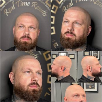 Real Time Results - Before and after of full head and barbershop line up hairline restoration. - Hair Loss Centers Near Me - Boise, Idaho Real Time Results - Before and after of full head and barbershop line up hairline restoration. - Hair Loss Centers Near Me - Boise, Idaho