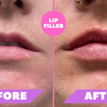 Healing Aesthetics - Lip filler. - Medical Spas Near Me - Hinsdale, Illinois Healing Aesthetics - Lip filler. - Medical Spas Near Me - Hinsdale, Illinois