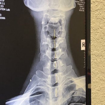 Vega Chiropractic - X rays were included in their $75 promotional offer for consult and adjustment. - Chiropractors Near Me - Ozark, Missouri