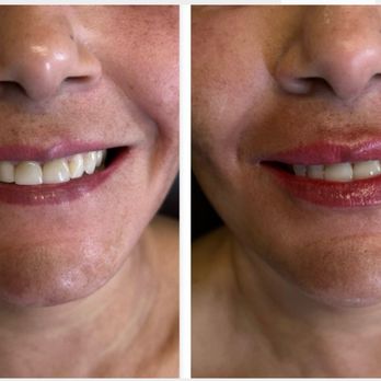 Be You Medical - before and after lip filler - Medical Spas Near Me - Alamo, California Be You Medical - before and after lip filler - Medical Spas Near Me - Alamo, California