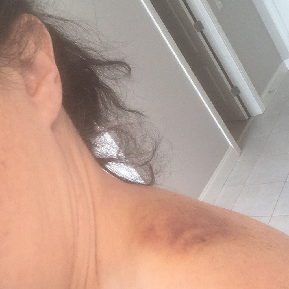 ATL Massage - 1 week later - Cupping mark on left shoulder - Massage Near Me - Dacula, Georgia ATL Massage - 1 week later - Cupping mark on left shoulder - Massage Near Me - Dacula, Georgia