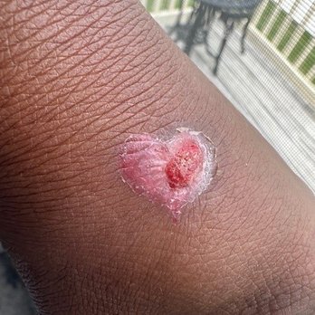 Inkwave Tattoos - My hand start to scab up because clearly this is a scar and not a tattoo - Tattoo Near Me - Myrtle Beach, South Carolina Inkwave Tattoos - My hand start to scab up because clearly this is a scar and not a tattoo - Tattoo Near Me - Myrtle Beach, South Carolina