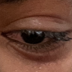 Courts Plus Fitness Center - My eye progressively over two weeks.