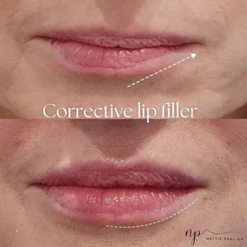 Anllo Center for Aesthetics - Laser Hair Removal Near Me - Allentown, Pennsylvania Anllo Center for Aesthetics - Laser Hair Removal Near Me - Allentown, Pennsylvania