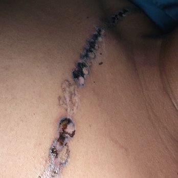 Gold n Glo Aesthetics - After healing for about two weeks - Laser Hair Removal Near Me - San Jose, California Gold n Glo Aesthetics - After healing for about two weeks - Laser Hair Removal Near Me - San Jose, California