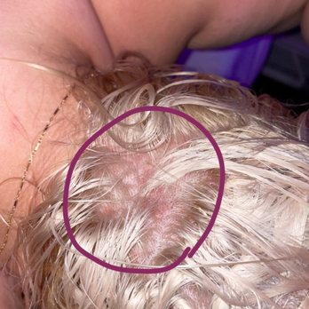 Studio Hair & Beauty - Burned scalp - Waxing Near Me - Dennis, Massachusetts Studio Hair & Beauty - Burned scalp - Waxing Near Me - Dennis, Massachusetts