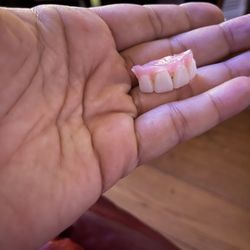 ClearChoice Dental Implant Center - Part of my implants that's fallen out