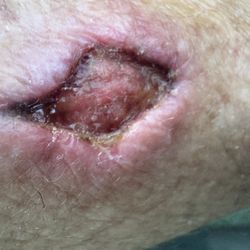 Honolulu Wellness Center - Three types of malignant skin cancer being treated topically with cannabis oil.