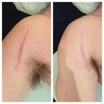 Kokoro Therapeutic Massage - Side by side comparison. 3 months of breaking up scar tissue post surgery. - Massage Therapy Near Me - Flagstaff, Arizona Kokoro Therapeutic Massage - Side by side comparison. 3 months of breaking up scar tissue post surgery. - Massage Therapy Near Me - Flagstaff, Arizona