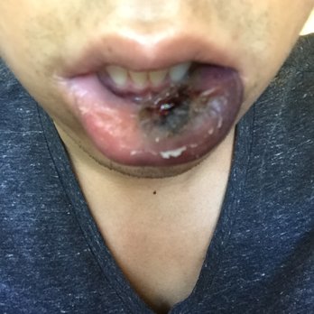 Mission Oral & Maxillofacial Surgery - 4th day Post-Op. Had a mucocele removed by Dr. Hyunh. Extreme infection. Lost my social life. - Oral Surgeons Near Me - Riverside, California