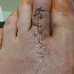 Kevin Richard Dux, DPM - Doctor Duke's horrible looking incision, crooked