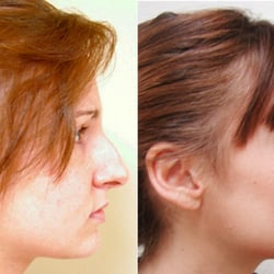Kimberly Henry, MD - Rhinoplasty with Dr. Kimberly Henry