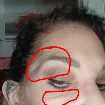 CG Cosmetic Surgery - Hanging skin after upper bleph to remove Hanging skin. Peanut heat after a facelift - Cosmetic Surgeons Near Me - Miami, Florida