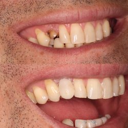 Heartwell Dental - Pt.'s adult tooth never grew in. Instead of extracting the tooth we did composite bonding to make it look like an adult tooth.