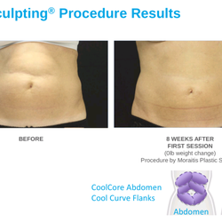 Moraitis Plastic Surgery - Coolsculpting of the abdomen by Moraitis Plastic Surgery