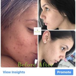 Revival Skin and Body Care - This picture shows before and after removal of grade 3-4 acne is finally under control. First picture only shows half way through treatment.
