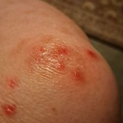 Skin Cancer & Cosmetic Dermatology Center - Further away picture of right knee from the close-up before this picture