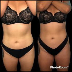 Esthetics by steph - Lipo cavitation. Results after 6 sessions. With Healthy eating and exercise