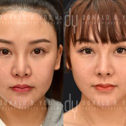 Donald B Yoo, MD, FACS - Revision Rhinoplasty with Rib Cartilage and DCF+ Silicone implant removal.