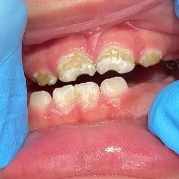 Milk Tooth Pediatric Dentistry and Wellness Shoppe - Before - Pediatric Dentists Near Me - Hermosa Beach, California