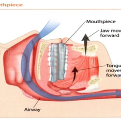 Premier Sleep Solutions - By protruding the mandible (lower jaw) forward, the obstructed airway is naturally held open without the need for CPAP masks,...