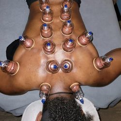 Cupping, myofacial release technique