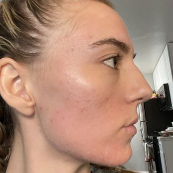 Acne Queen Skin Care - Look at that progress. I have only 40 spf sunscreen on. - Skin Care Near Me - Walnut Creek, California Acne Queen Skin Care - Look at that progress. I have only 40 spf sunscreen on. - Skin Care Near Me - Walnut Creek, California