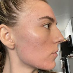 Acne Queen Skin Care - Look at that progress. I have only 40 spf sunscreen on.
