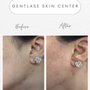 GentLase Skin Center