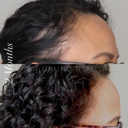 Dr. Andrea Grund Regenerative Skin & Hair - 2 Month Results.  Start here https://linktr.ee/drgrund
