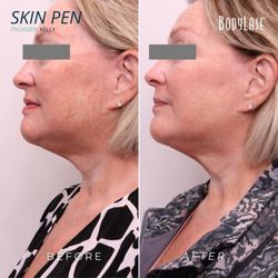 BodyLase Med Spa - Microneedling
