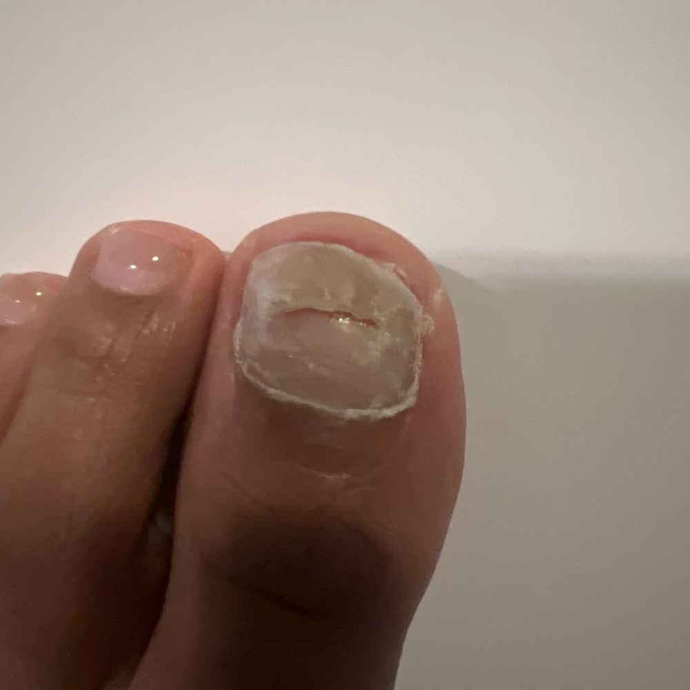 Toenail that's infected Toenail that's infected