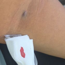 CSL Plasma - The 1st picture is right after the long bruise is hours later.