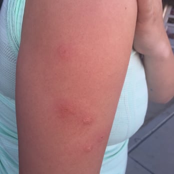 Candy Cane Inn - Bed Bug Bites - Hotels Near Me - Anaheim, California