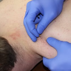 STEP Therapies - Trigger Point/Functional Dry Needling... the pain management technique that is sweeping the nation!!