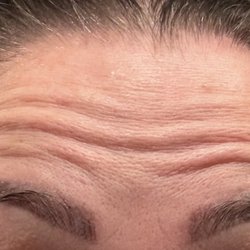MD Esthetics Virginia Beach - Forehead wrinkles 2 weeks after Botox treatment. Find somewhere else to go.
