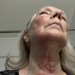 Burns after facial Burns after facial