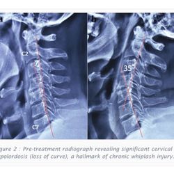 David Wade, DC - Returning the normal cervical curve
