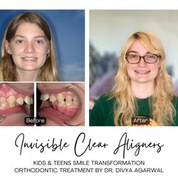 Newport-Mesa Orthodontics & Family Dentistry - See how orthodontic treatment with clear aligners fixed Maya's "front teeth sticking out," giving her a straight, confident smile!